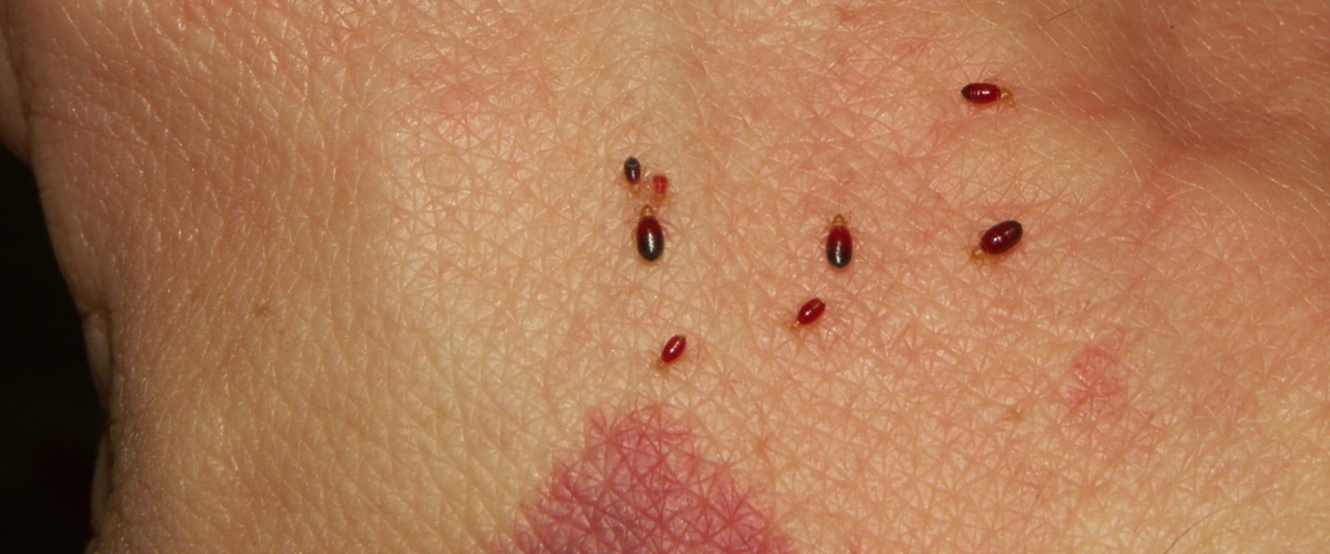Can bed bugs make you sick?