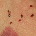 Can bed bugs make you sick?